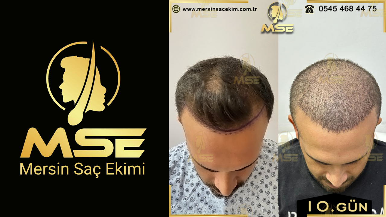 Mersin Saç Ekimi